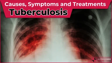 Tuberculosis article header – First Aid Article in Nerang